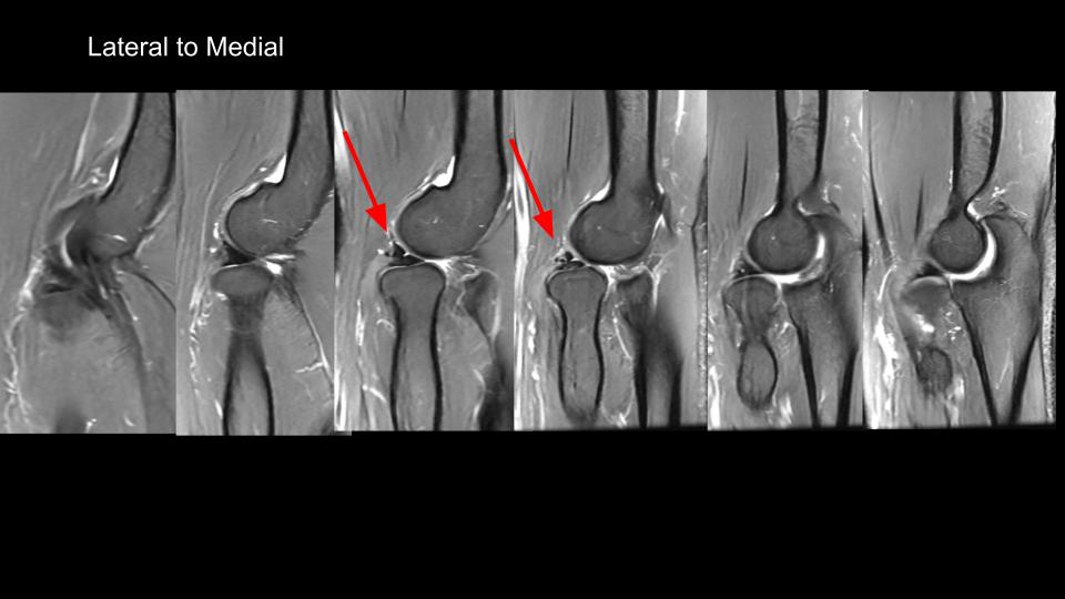 Figure 2 for case Volar dislocation of the radial head